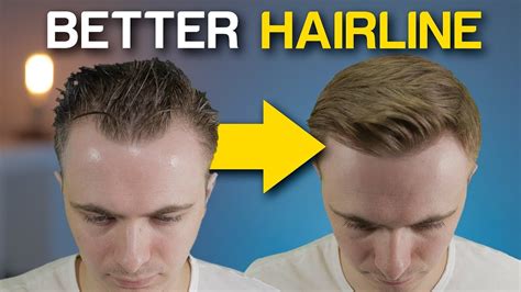Tips for Choosing the Right Expert for Your Magic Rzy Hairline Fix